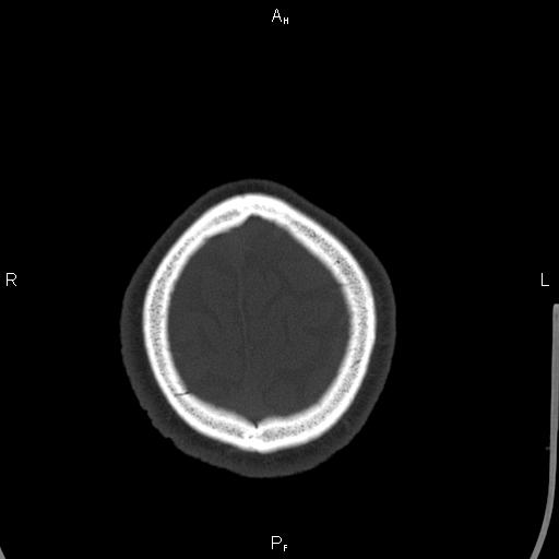 Cerebellopontine angle arachnoid cyst (Radiopaedia 85149-100704 Axial bone window 49).jpg