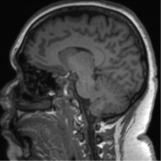File:Cerebellopontine angle meningioma (Radiopaedia 48434-53348 Sagittal T1 52).png