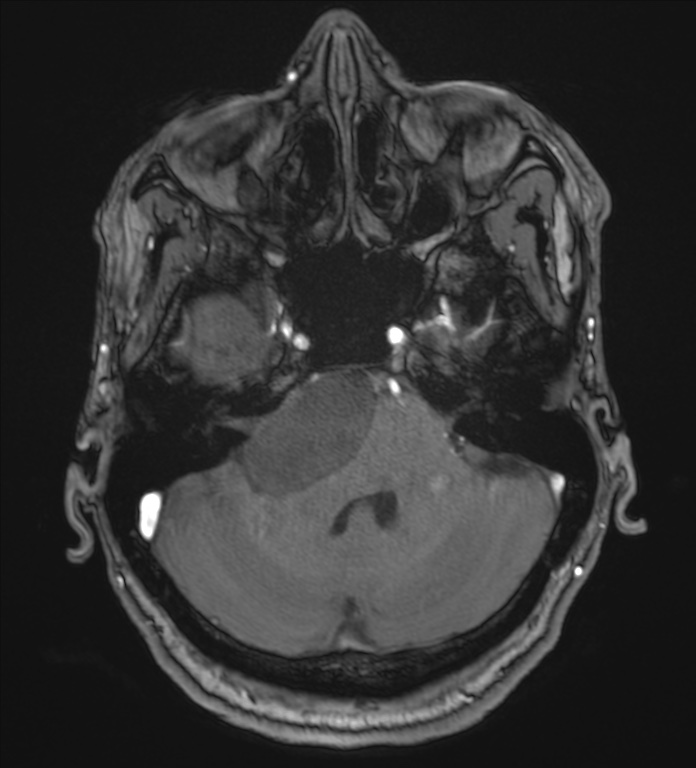 Cerebellopontine angle meningioma (Radiopaedia 72983-83680 Axial MRA 27).jpg