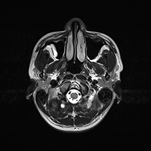 File:Cerebral abscess (Radiopaedia 24212-24478 Axial T2 10).jpg