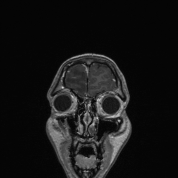 Cerebral abscess (Radiopaedia 24212-24478 Coronal T1 C+ 39).jpg