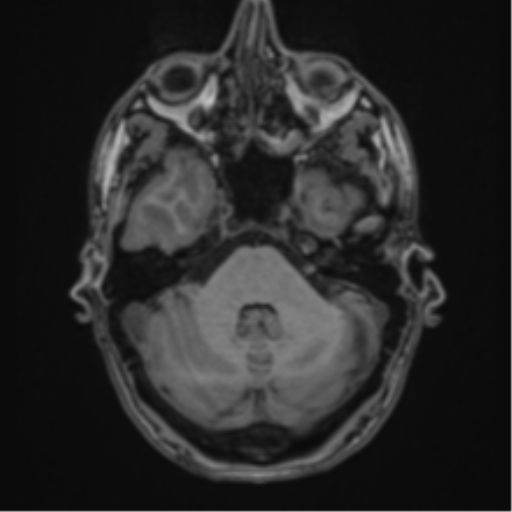 File:Cerebral abscess (Radiopaedia 60342-68009 Axial T1 9).png