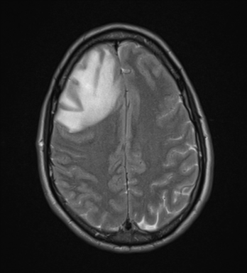 File:Cerebral abscess (Radiopaedia 60342-68009 Axial T2 26).png