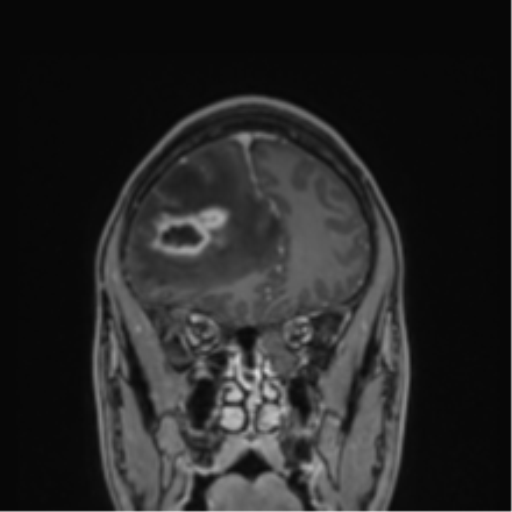 Cerebral abscess (Radiopaedia 60342-68009 H 40).png