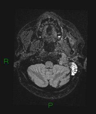 Cerebral abscess and subdural empyema (Radiopaedia 84436-99779 Axial FLAIR 72).jpg
