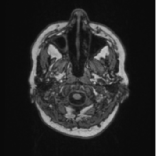 File:Cerebral abscess from pulmonary arteriovenous malformation (Radiopaedia 86275-102291 Axial T1 5).png