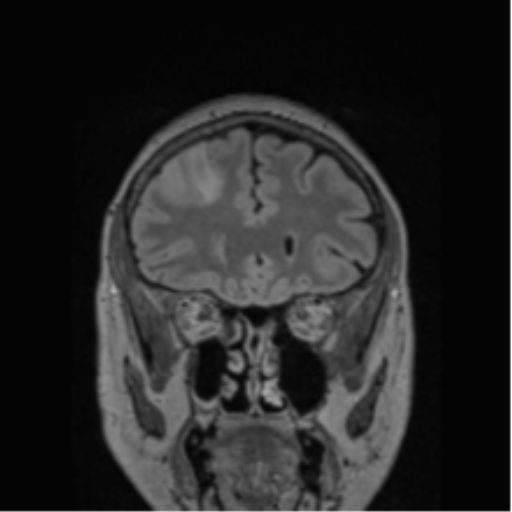 Cerebral abscess from pulmonary arteriovenous malformation (Radiopaedia 86275-102291 Coronal FLAIR 66).png