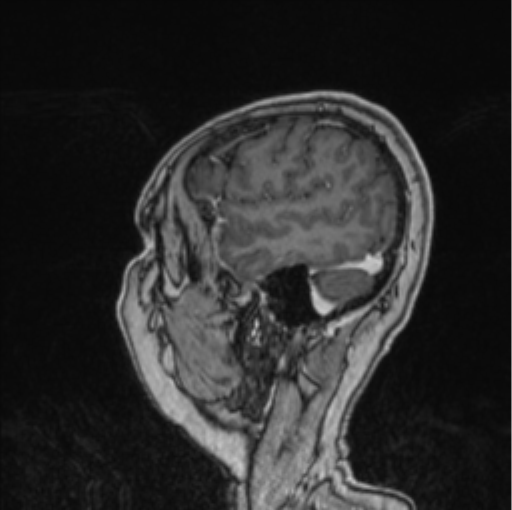 Cerebral abscess from pulmonary arteriovenous malformation (Radiopaedia 86275-102291 Sagittal T1 C+ 15).png