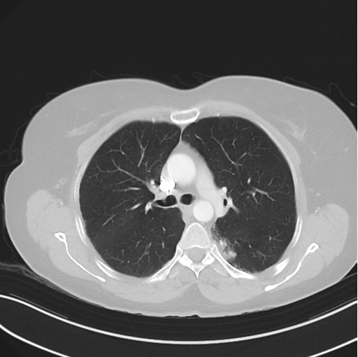Cerebral abscess from pulmonary arteriovenous malformation (Radiopaedia 86275-102292 Axial lung window 24).png