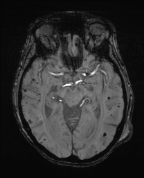 File:Cerebral amyloid angiopathy-related inflammation (Radiopaedia 74836-85849 Axial SWI 31).jpg