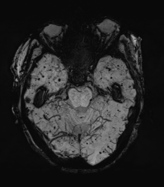 Cerebral amyloid angiopathy (Radiopaedia 46082-50433 Axial SWI MIP 24).png