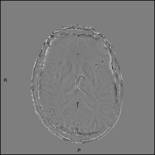 Cerebral amyloid angiopathy (Radiopaedia 77506-89664 H 58).jpg