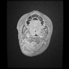 Cerebral and spinal tuberculosis (Radiopaedia 90489-107837 Axial T1 C+ 6).jpg