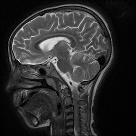 File:Cerebral and spinal tuberculosis (Radiopaedia 90489-107837 Sagittal T2 10).jpg