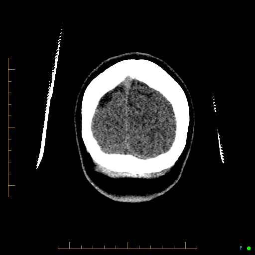File:Cerebral arteriovenous malformation (AVM) (Radiopaedia 78162-90706 Coronal non-contrast 91).jpg