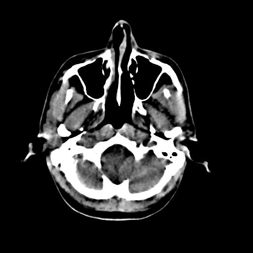 Cerebral arteriovenous malformation (Radiopaedia 28518-28759 Axial non-contrast 8).jpg