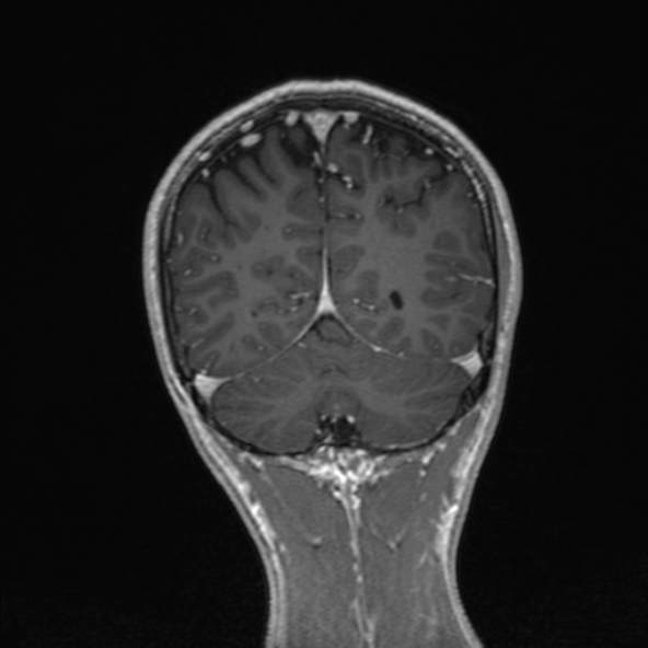Cerebral arteriovenous malformation (Radiopaedia 30198-30813 F 45).jpg