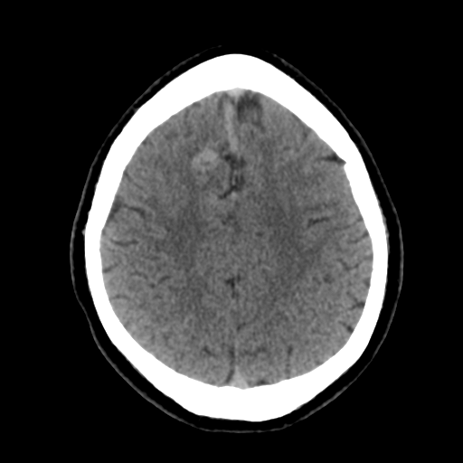 File:Cerebral arteriovenous malformation (Radiopaedia 39259-41505 Brain Ax 5mm 21).png