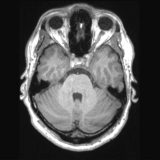 Cerebral arteriovenous malformation (Radiopaedia 39259-41506 Axial T1 24).png