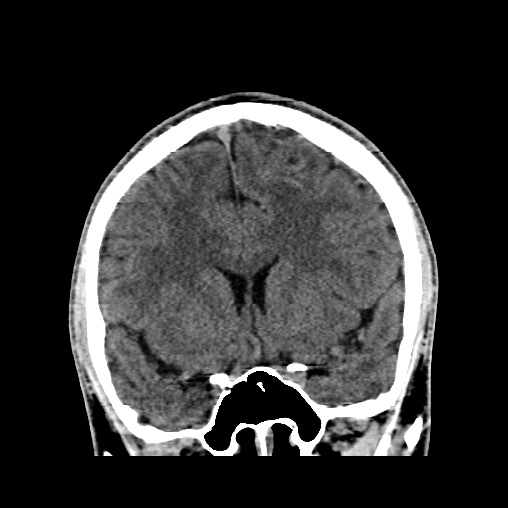 Cerebral arteriovenous malformation (Radiopaedia 61964-70028 Coronal non-contrast 24).jpg