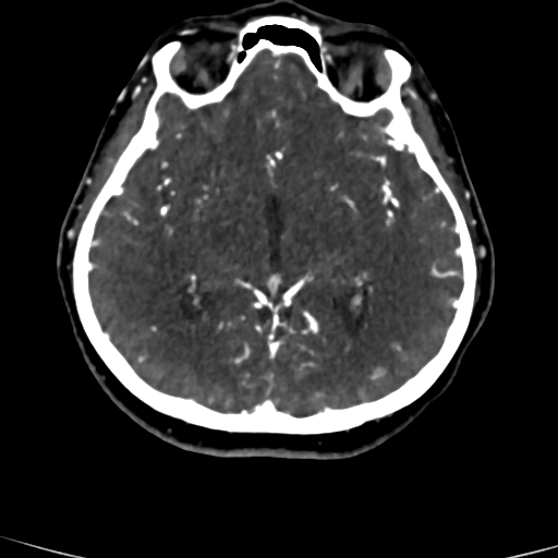 Cerebral arteriovenous malformation (Radiopaedia 73830-84645 Axial C+ delayed 50).jpg
