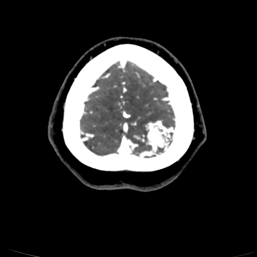 Cerebral arteriovenous malformation (Radiopaedia 73830-84645 Axial C+ delayed 7).jpg