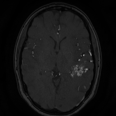 Cerebral arteriovenous malformation (Radiopaedia 74411-85654 Axial MRA 71).jpg