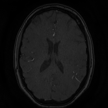 Cerebral arteriovenous malformation (Radiopaedia 74411-85654 Axial MRA 94).jpg