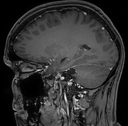 Cerebral arteriovenous malformation (Radiopaedia 74411-85654 Sagittal T1 C+ 46).jpg