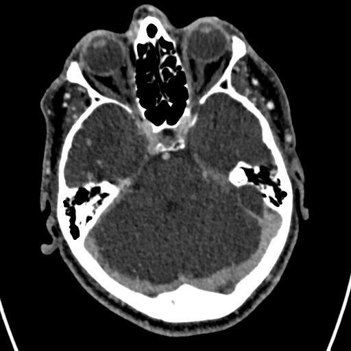 Cerebral arteriovenous malformation (Radiopaedia 78188-90746 Axial C+ delayed 53).jpg