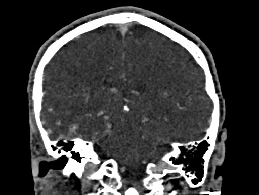 Cerebral arteriovenous malformation (Radiopaedia 78188-90746 Coronal C+ delayed 73).jpg
