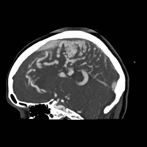 File:Cerebral arteriovenous malformation (Radiopaedia 79677-92888 C 24).jpg