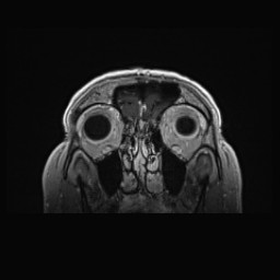 Cerebral arteriovenous malformation (Radiopaedia 84015-99245 Coronal T1 C+ 23).jpg