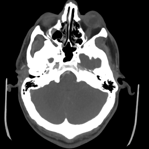Cerebral arteriovenous malformation (Spetzler-Martin grade 2) (Radiopaedia 41262-44076 E 13).png