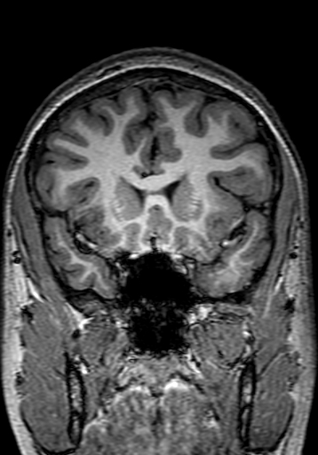 Cerebral arteriovenous malformation at posterior body of corpus callosum (Radiopaedia 74111-84925 Coronal T1 101).jpg
