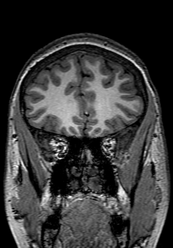 Cerebral arteriovenous malformation at posterior body of corpus callosum (Radiopaedia 74111-84925 Coronal T1 65).jpg