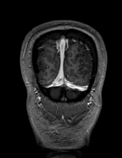 Cerebral arteriovenous malformation at posterior body of corpus callosum (Radiopaedia 74111-84925 K 347).jpg