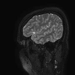 Cerebral arteriovenous malformation at posterior body of corpus callosum (Radiopaedia 74111-84925 Sagittal T2 117).jpg