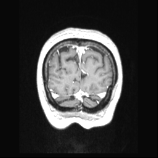 Cerebral arteriovenous malformation with hemorrhage (Radiopaedia 34422-35737 Coronal T1 C+ 13).png
