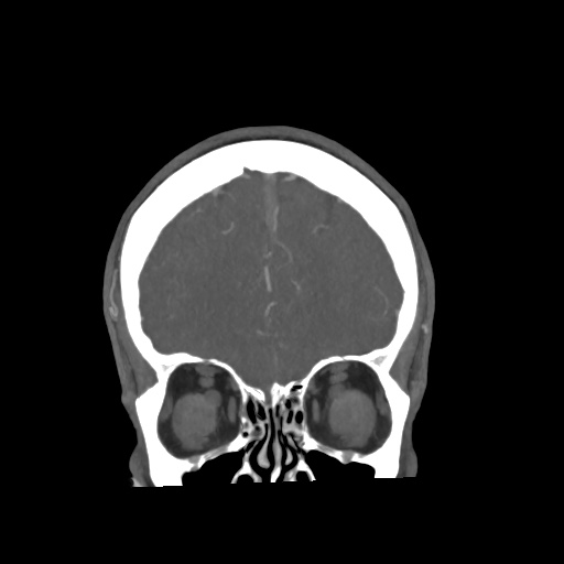 Cerebral arteriovenous malformation with lobar hemorrhage (Radiopaedia 35598-57216 C 19).jpg
