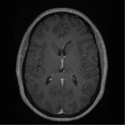 Cerebral cavernoma and development venous anomaly (Radiopaedia 37603-39482 Axial T1 C+ 43).png