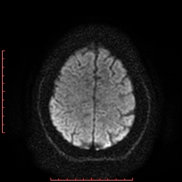 File:Cerebral cavernous malformation (Radiopaedia 26177-26306 Axial DWI 17).jpg