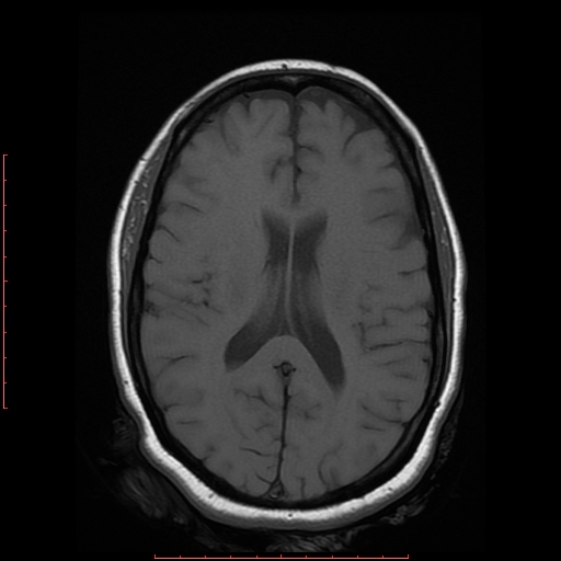 File:Cerebral cavernous malformation (Radiopaedia 26177-26306 Axial T1 13).jpg