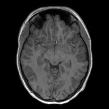 Cerebral cavernous venous malformation (Radiopaedia 70008-80021 Axial T1 31).jpg