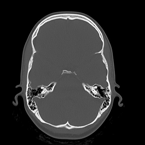Cerebral cavernous venous malformation (Radiopaedia 70008-80022 Axial bone window 13).jpg