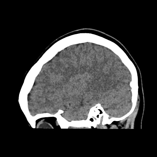 Cerebral cavernous venous malformation (Radiopaedia 70008-80022 C 42).jpg