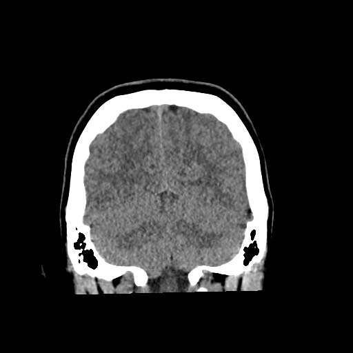 Cerebral cavernous venous malformation (Radiopaedia 70008-80022 non-contrast 56).jpg