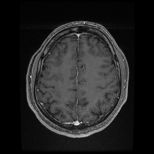 Cerebral cavernous venous malformation (Zabramski type II) (Radiopaedia 85511-101198 Axial T1 C+ fat sat 27).jpg