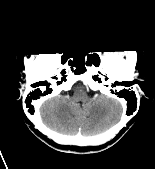 File:Cerebral cavernous venous malformations (Radiopaedia 48117-52945 Axial C+ delayed 9).png