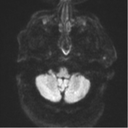 Cerebral embolic infarcts (embolic shower) (Radiopaedia 57395-64342 Axial DWI 43).png